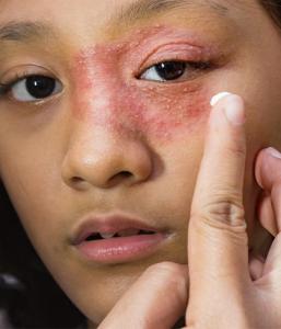 Best Eczema treatment in Dubai - Dr Batra’s Homeopathy