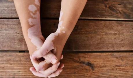 Effective Vitiligo Treatment, Hyperpigmentation Treatment In Dubai | Dr Batra’s Homeopathy